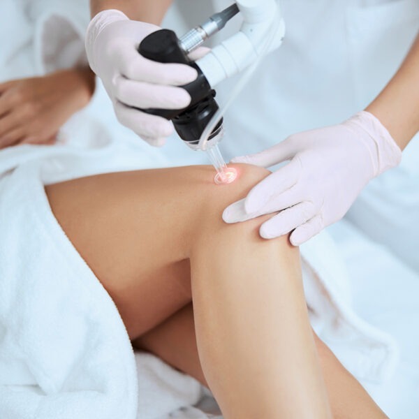 Mit dem medizinischen Laser werden Besenreiser verschweißt und vom Körper dann selbststänsdig abgebaut.