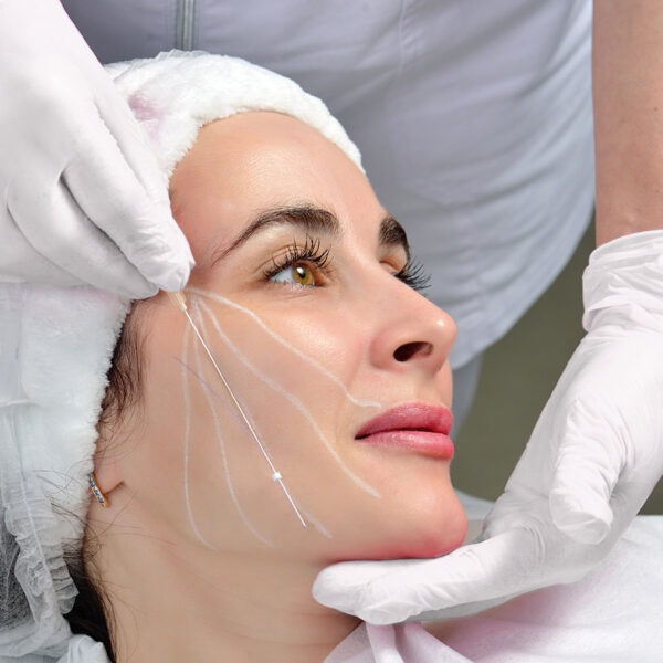 Mit Fadenlifting können Gesichtspartien großflächig gestrafft und aufgepolstert werden