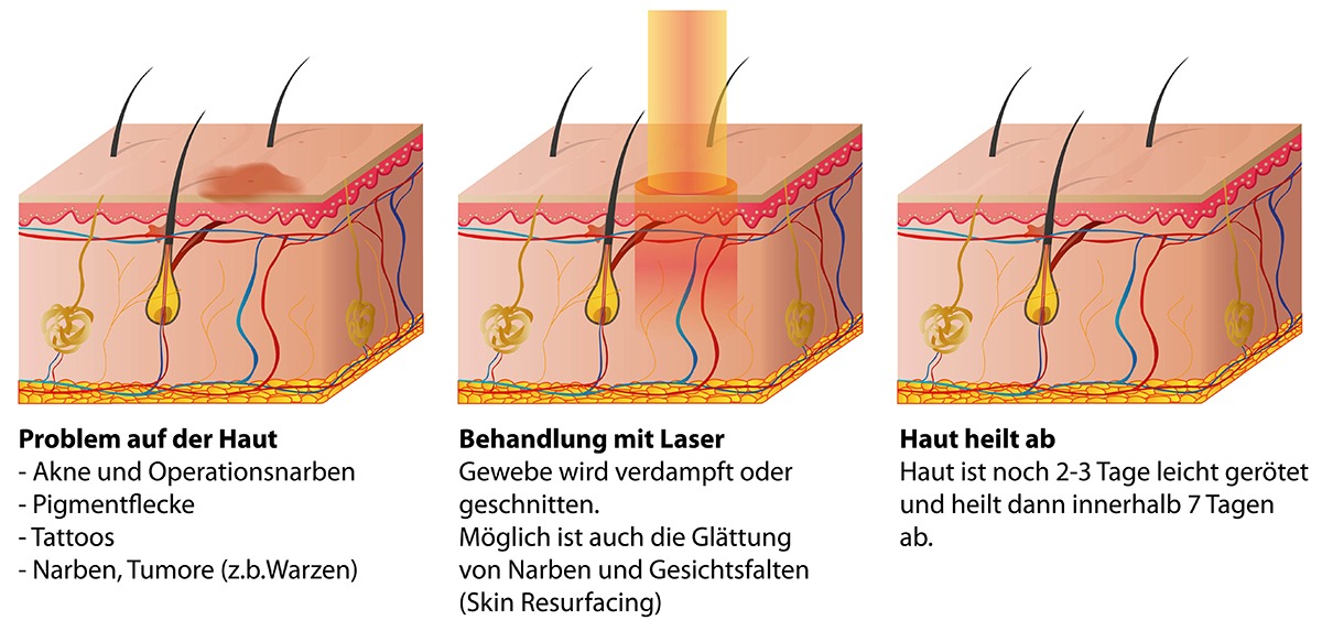 Ablauf der Faltenbehandlung mit dem Laser