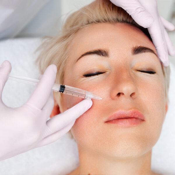 Sogar tief eingegrabene Falten können oft durch Unterpolsterung mit Hyaluron verbessert werden.