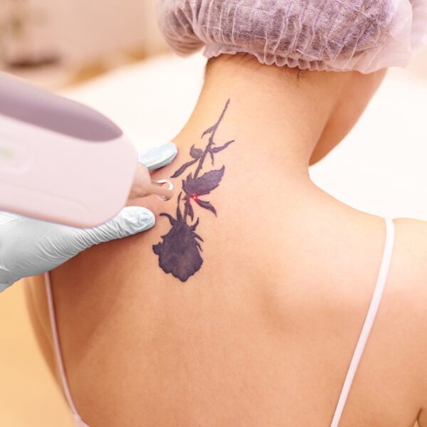 Bei der Tattoo-Entfernung zerstört der Laser die Farbpigmente der Tätowierung