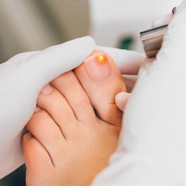 Mit Nagelpilz befallene Nägel werden vom Pilz zerstört und schmerzen. Der Arzt behandelt sie mit dem Laser.