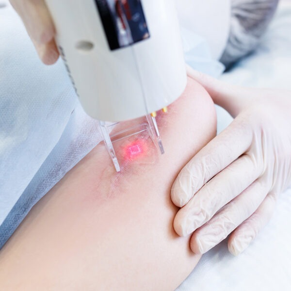 Die Laser-Behandlung kann auffällige Narben glätten und regt die Haut zur Heilung an.