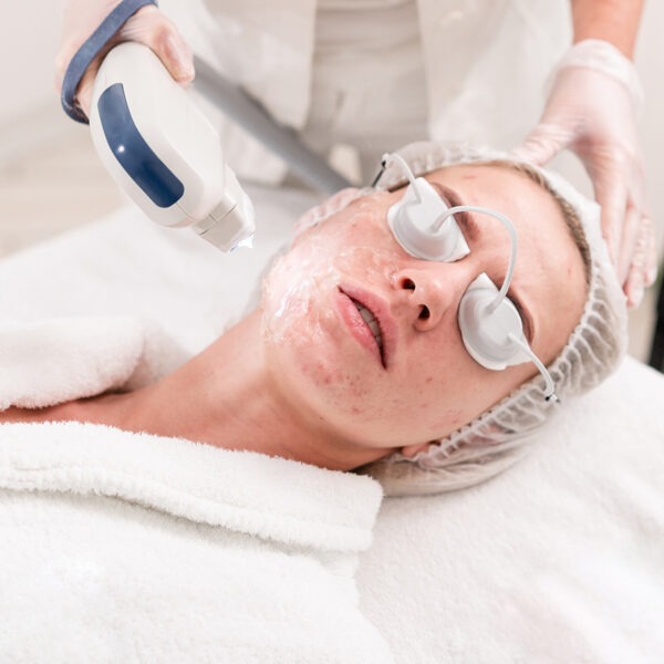 Mit einer Laser-Behandlung kann der Arzt die Rosacea-Symptome deutlich verbessern.