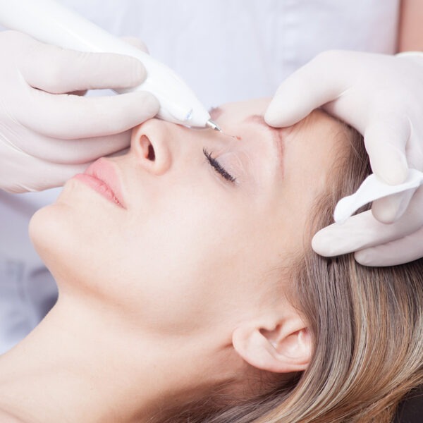 Die effizienteste Behandlung zur Warzen-Entfernung ist der medizinische Laser.